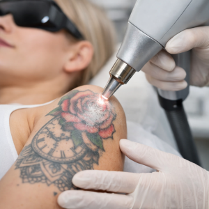 laserowe usunięcie tatuażu kolor 150-300 cm²